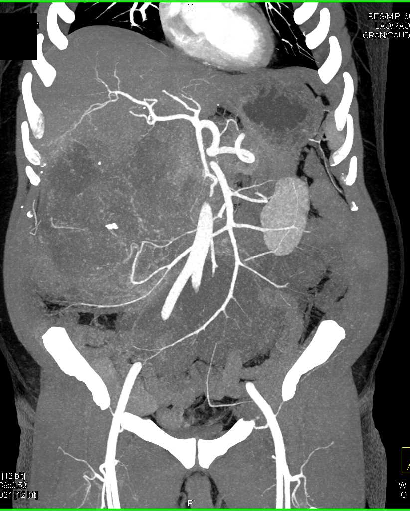 Hepatome with Neovascularity - CTisus CT Scan