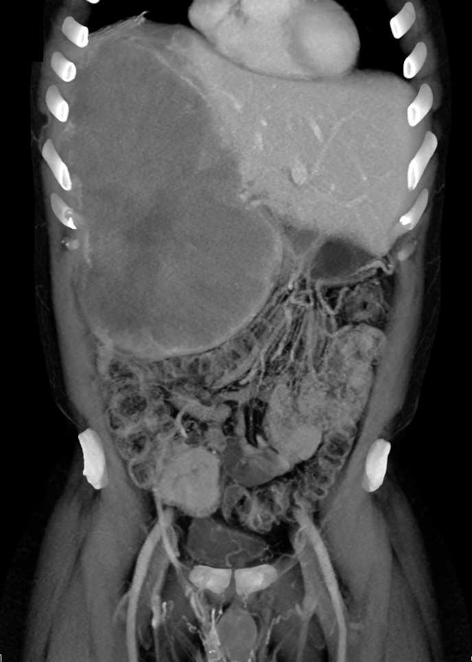 Hepatoma - CTisus CT Scan