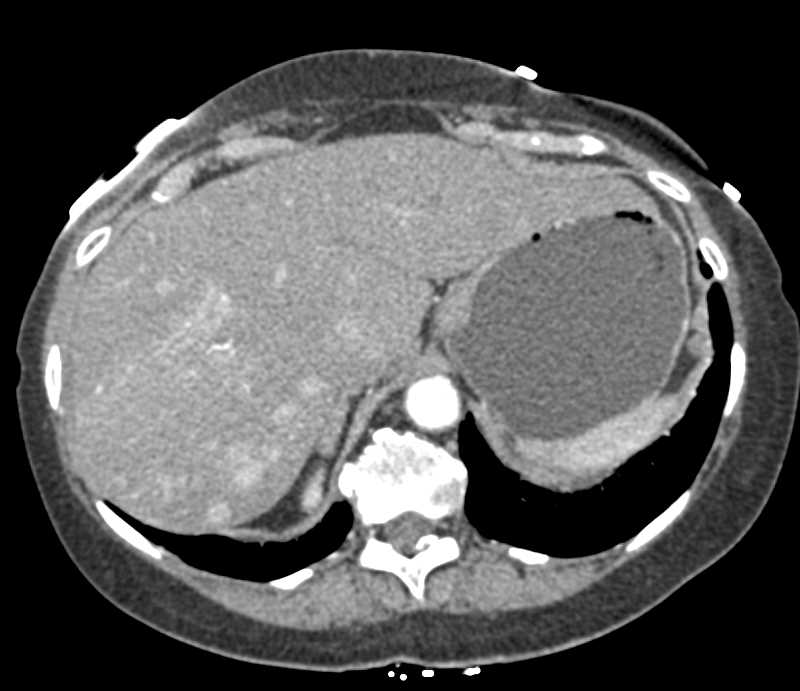 Hepatoma with Active Bleed - CTisus CT Scan