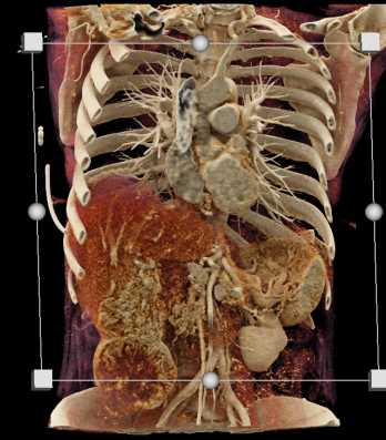 Hepatoma with Active Bleed - CTisus CT Scan