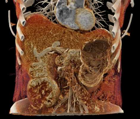 Hepatoma with Active Bleed - CTisus CT Scan