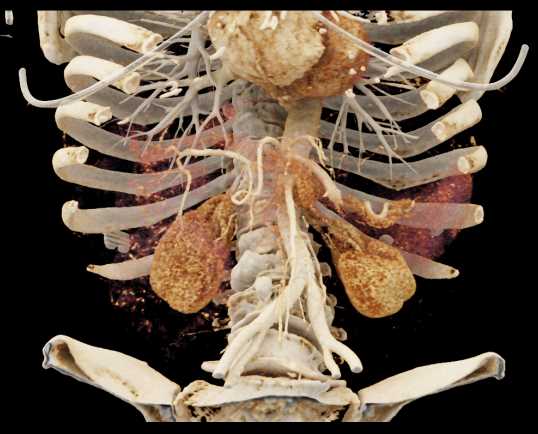 Hepatoma with Active Bleed - CTisus CT Scan