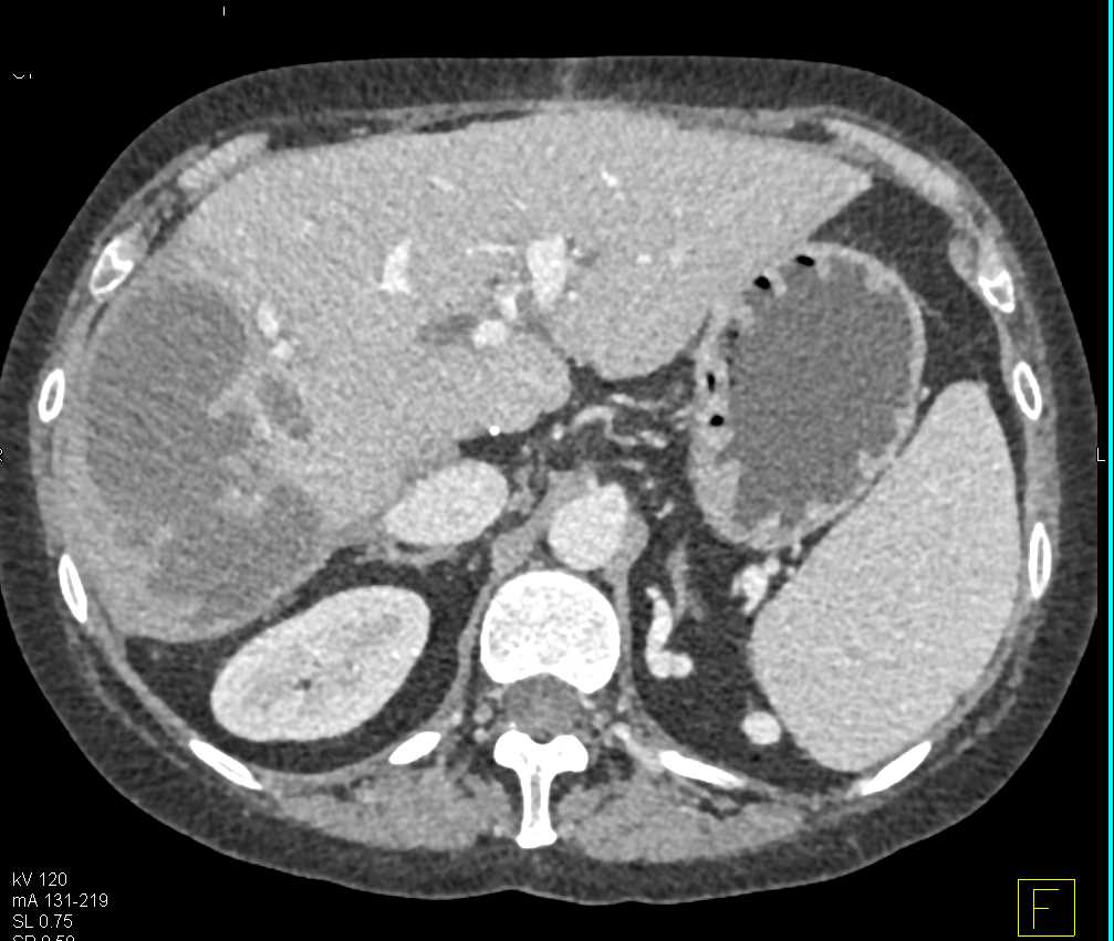 Liver Infarct - CTisus CT Scan
