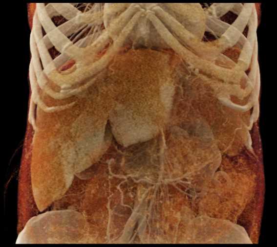 Liver Infarct - CTisus CT Scan
