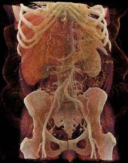 Hepatoma - CTisus CT Scan
