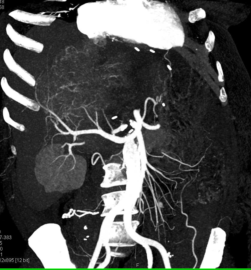 Cholangiocarcinoma - CTisus CT Scan