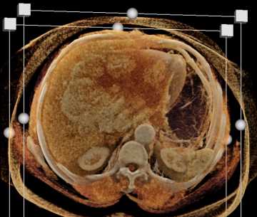 Cholangiocarcinoma - CTisus CT Scan