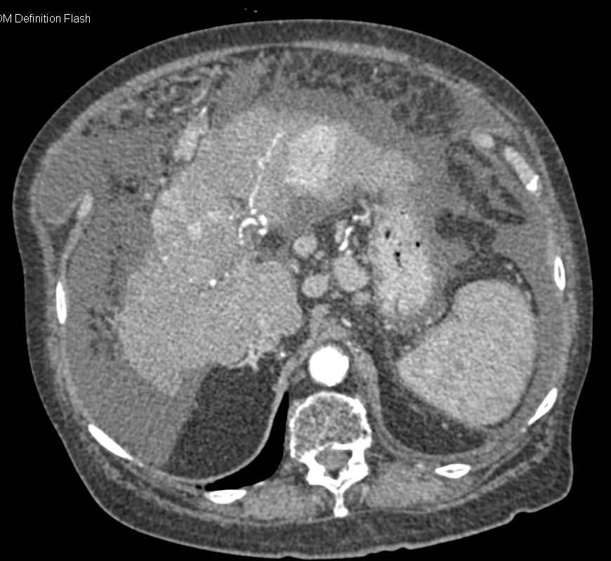 Hepatocellular Carcinoma (Hepatoma) in a Cirrhotic Liver - CTisus CT Scan