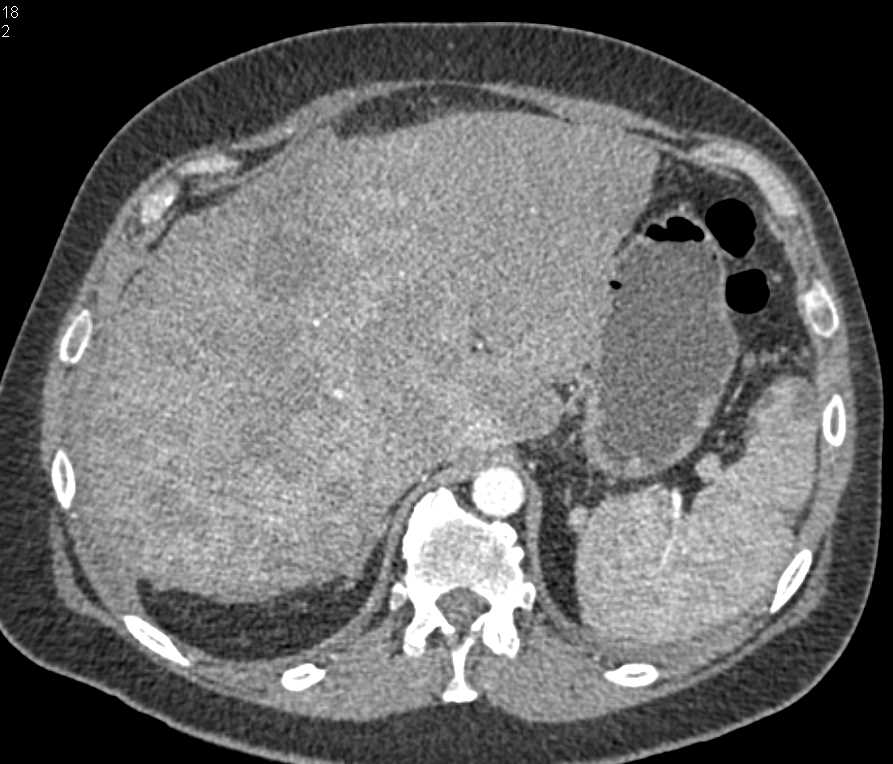 Incidental Pulmonary Embolism (PE) in Right Lower Lung in Patient with Hepatocellular Carcinoma (Hepatoma) - CTisus CT Scan