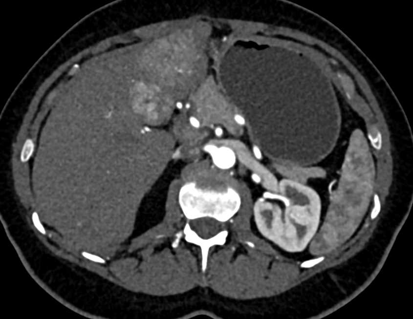 FNH and Hemangiomas of the Liver - CTisus CT Scan