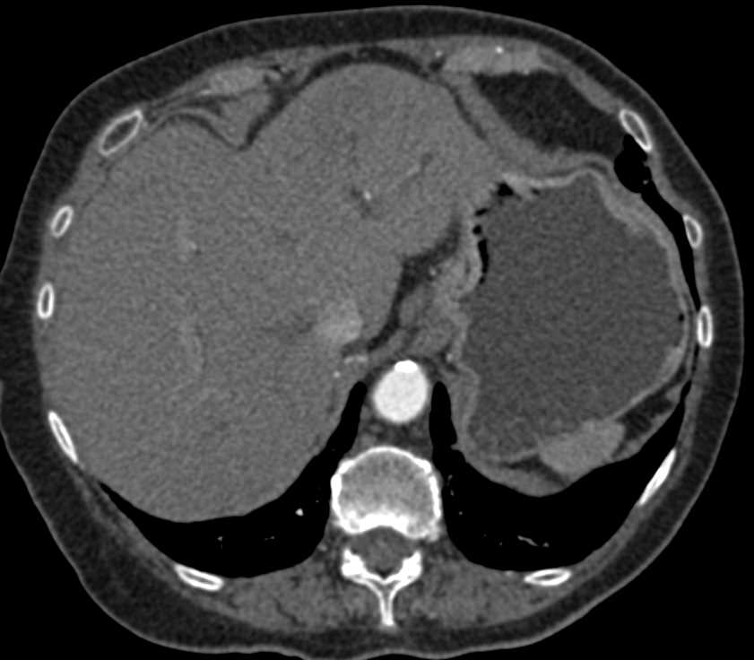 Hepatoma - CTisus CT Scan