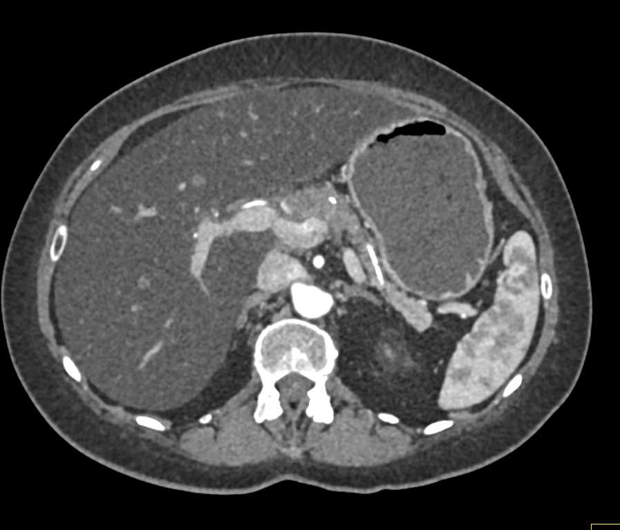 Fatty Infiltration of the Liver - CTisus CT Scan