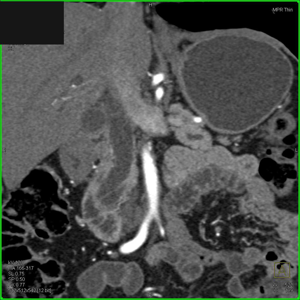 Ampullary Carcinoma with Double Duct Sign - CTisus CT Scan