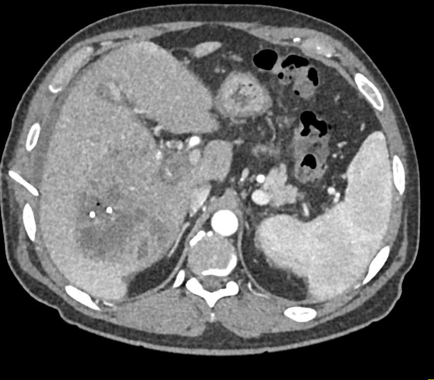 Cholangiocarcinoma - CTisus CT Scan