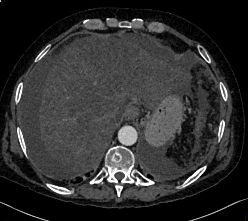 Cirrhosis with Parenchymal Liver Disease and Ascites - CTisus CT Scan