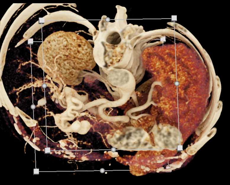 Arteriovenous (AV) Fistulae Liver - CTisus CT Scan