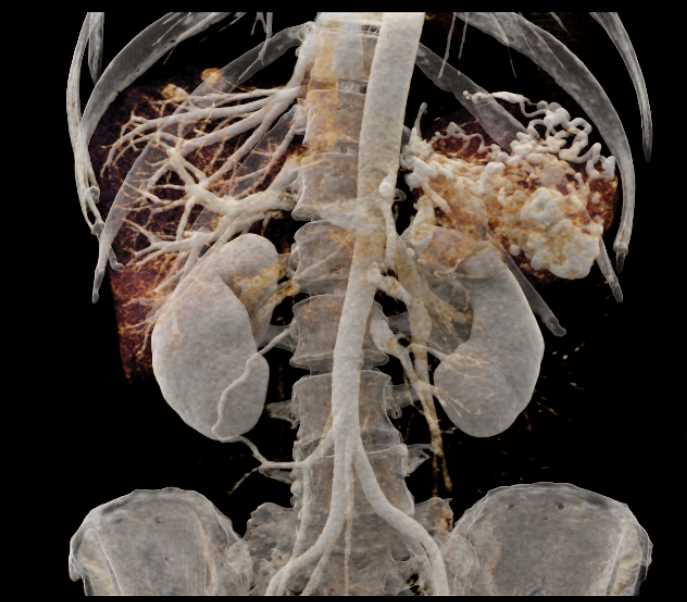 Vascular Metastases to the Liver and Spleen - CTisus CT Scan