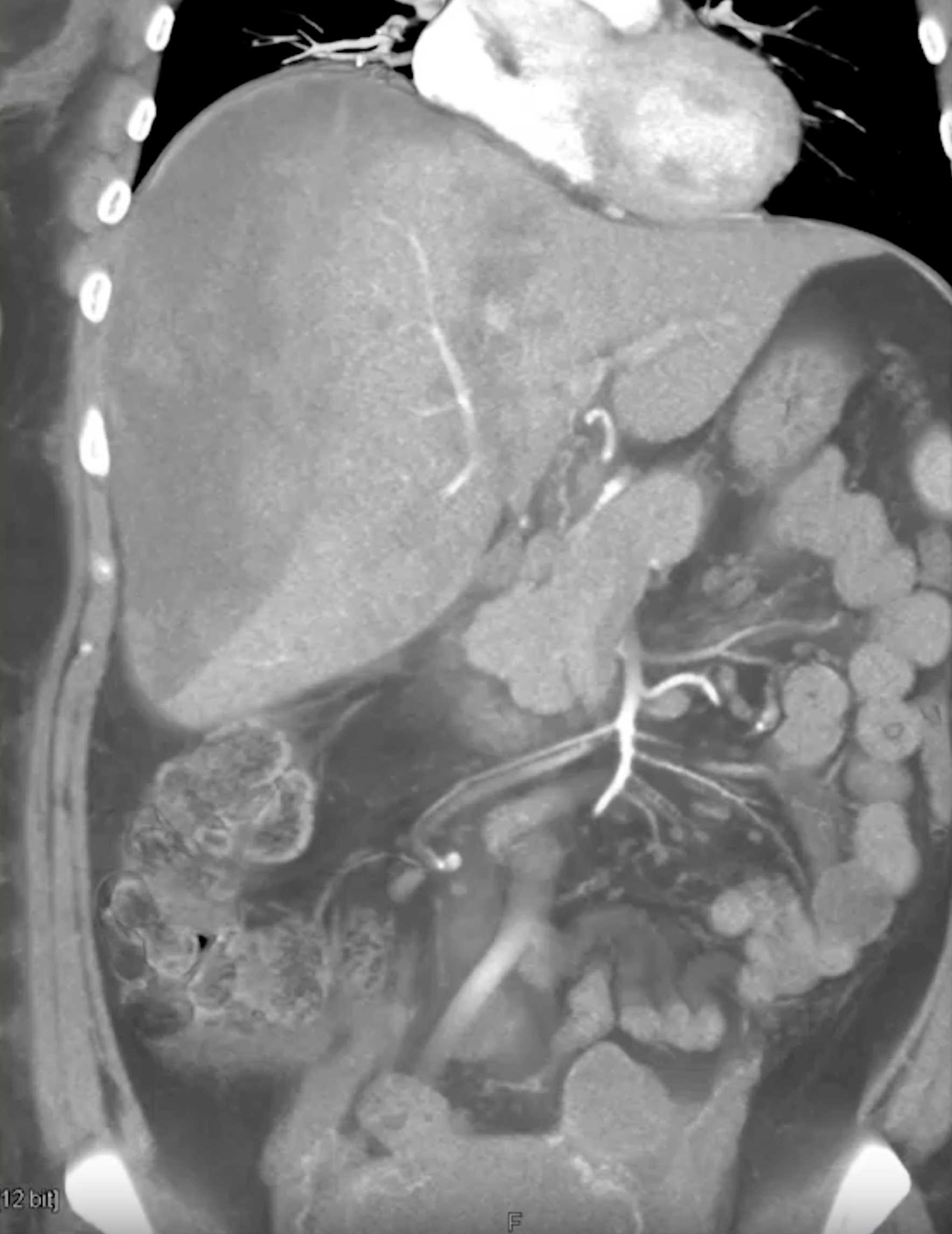 HELLP Post Partum with Liver Bleed and Infarction - CTisus CT Scan