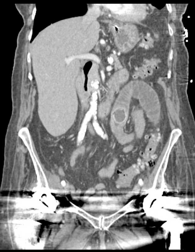 Cholelithiasis - CTisus CT Scan