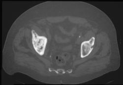 Paget's Disease - CTisus CT Scan