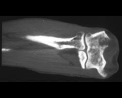 Metastasis From Lung Cancer - CTisus CT Scan