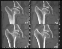 Diastrophic Dwarf - CTisus CT Scan