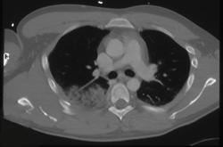 Rib and Scapular Fractures With Lung Contusion - CTisus CT Scan