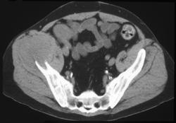 Metastatic Cancer to Bone With CT Guided Biopsy - CTisus CT Scan