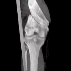 Femur Fracture - CTisus CT Scan