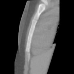 Normal Sternum - CTisus CT Scan