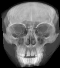 Normal Facial Bones - CTisus CT Scan