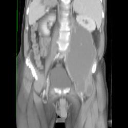 Tuberculosis (TB) - psoas Abscess - CTisus CT Scan