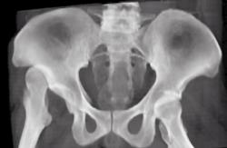Congenital Hip Dysplasia - CTisus CT Scan