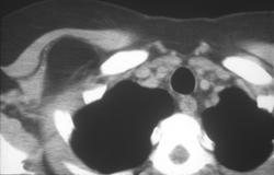 Liposarcoma - CTisus CT Scan