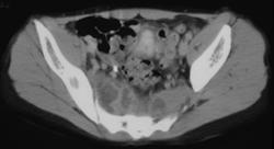 Infection of the Sacrum With Soft Tissue Abscess - CTisus CT Scan