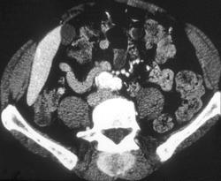 Lung Cancer Metastatic to Muscle - CTisus CT Scan