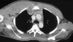 Chest Wall Abscess Extends Into the Anterior Mediastinum - CTisus CT Scan