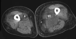 Abscess With Myositis - CTisus CT Scan