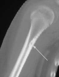 Osteoid Osteoma - CTisus CT Scan