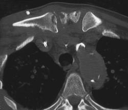Osteomyelitis S/c Joint - CTisus CT Scan