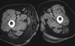 Necrotizing Fasciitis - CTisus CT Scan