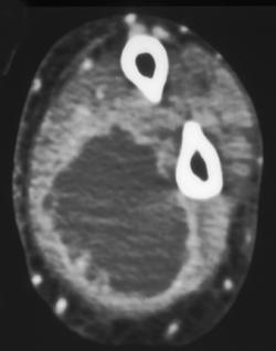 Abscess - CTisus CT Scan