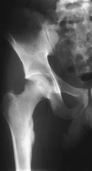 Osteoid Osteoma - CTisus CT Scan