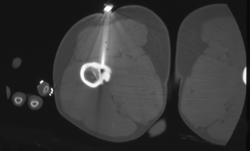 Osteoid Osteoma With Ablation - CTisus CT Scan