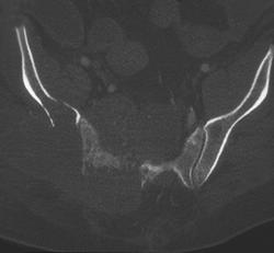 Chordoma - CTisus CT Scan
