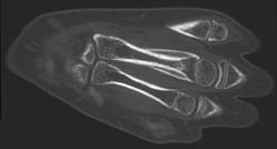 Osteomyelitis With Periosteal Reaction - CTisus CT Scan