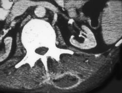 Necrotizing Fasciitis - CTisus CT Scan