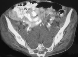 Neurofibromatosis - CTisus CT Scan