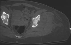 Osteomyelitis - Intravenous Drug Abuse (IVDA) - CTisus CT Scan