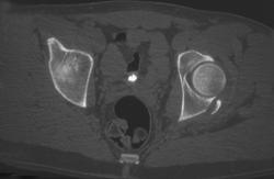 Posterior Lip Fracture - CTisus CT Scan
